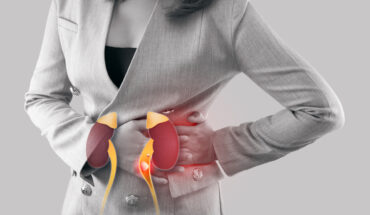 Kidney Stones: Causes, Symptoms & Treatment Options