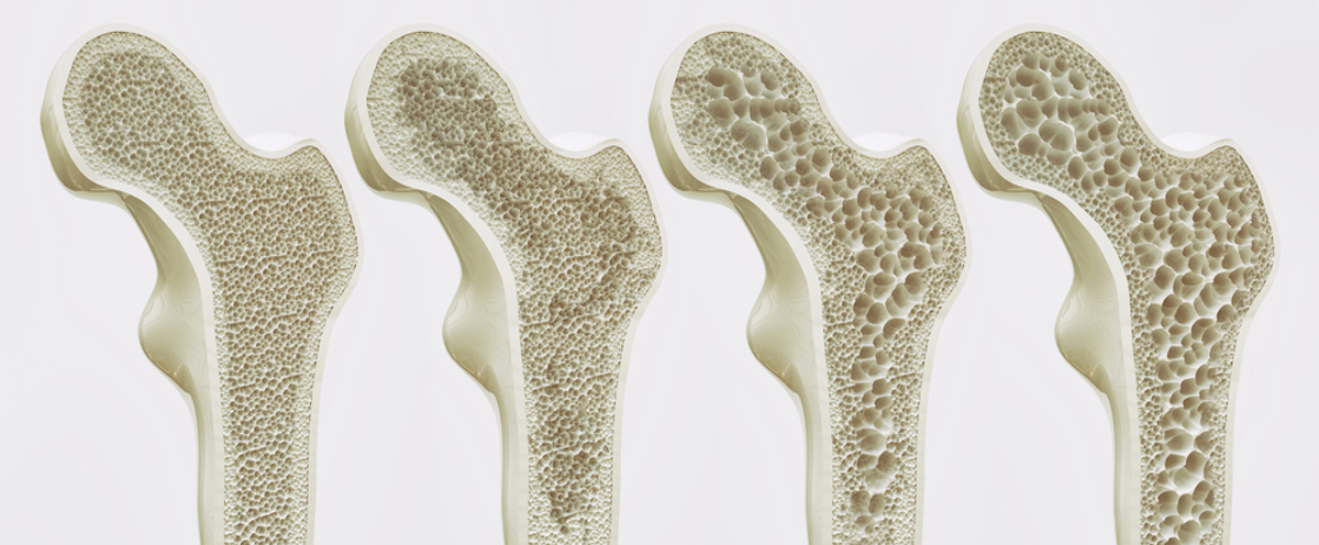 Vector osteoporosis getting worse and how that looks inside the bones