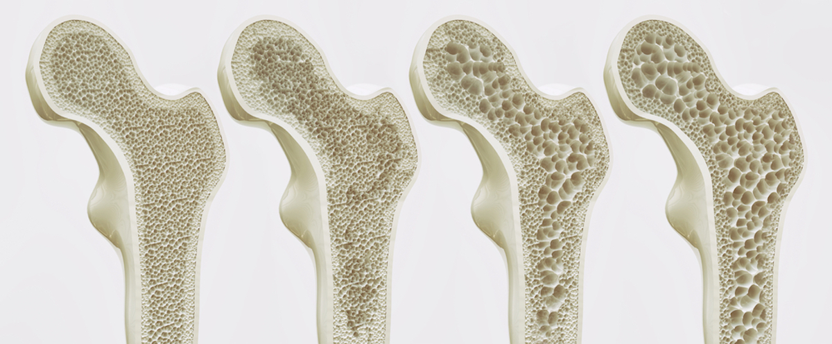 Vector Osteoporosis Getting Worse and How That Looks Inside the Bones