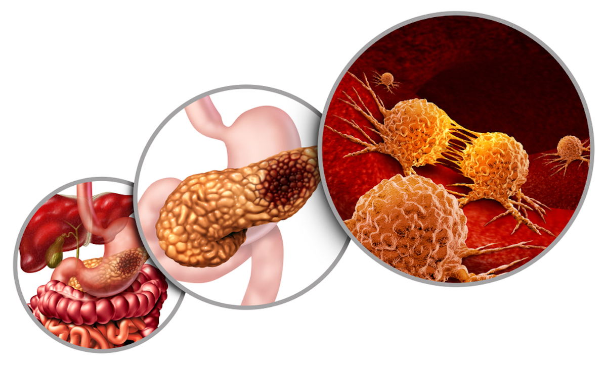 pancreatic cancer anatomy diagram and pancreatic malignant tumor concept as a medical symbol of a digestive gland body part as mutating cells with 3D illustration elements.
