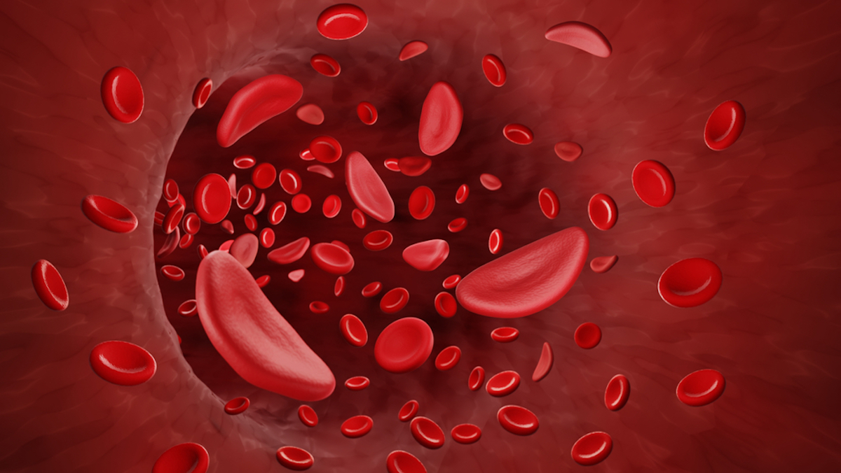 Sickle cells in blood stream, Sickle cell anemia 3d illustration