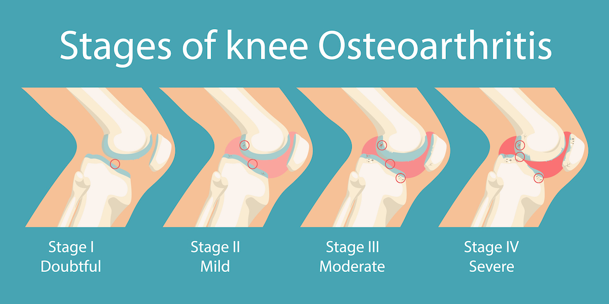 Stages of knee Osteoarthritis. Human Knee Osteoarthritis infographics. Vector illustration.