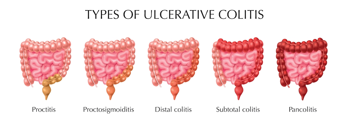 Ulcerative colitis types infographics including proctitis distal colitis pancolitis proctosigmoiditis subtotal colitis realistic vector illustration
