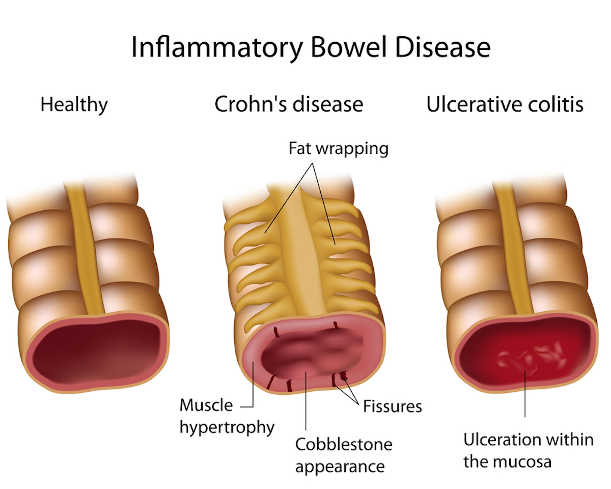 Vergelijk Crohns en colitis ulcerosa
