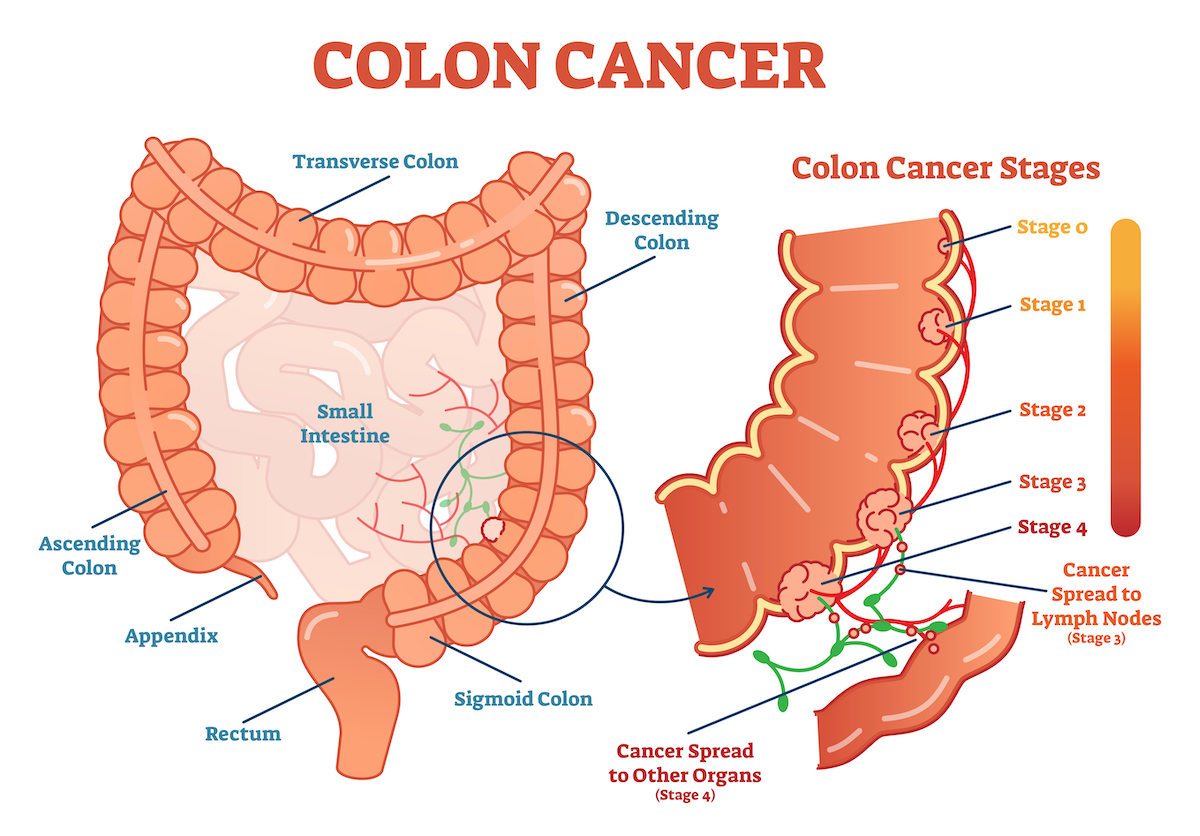 Medical vector illustration of colon cancer, an anatomical diagram showing cancer stages and spread to other organs.