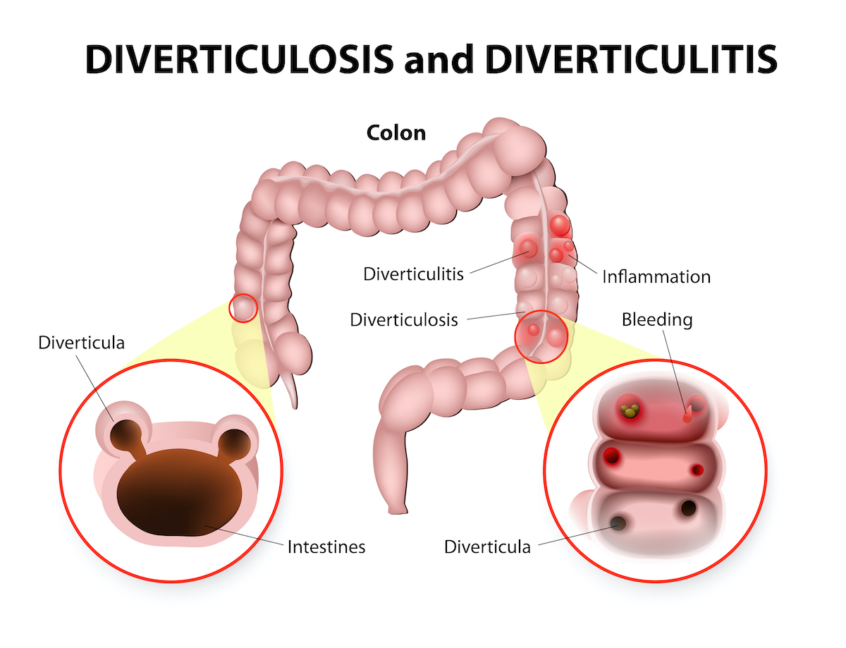 Diverticulosis and Diverticulitis. Diverticula are sacs that develop in the colon wall. These small sacs bulge outward through weak spots in the colon wall.