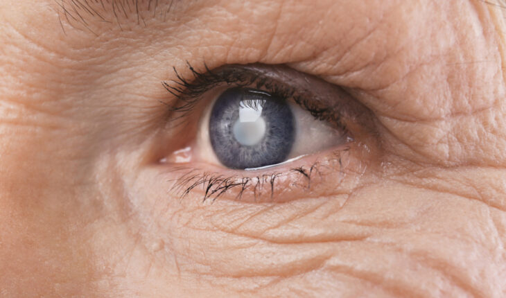 Glaucoma: Causes, Symptoms & Treatment Options
