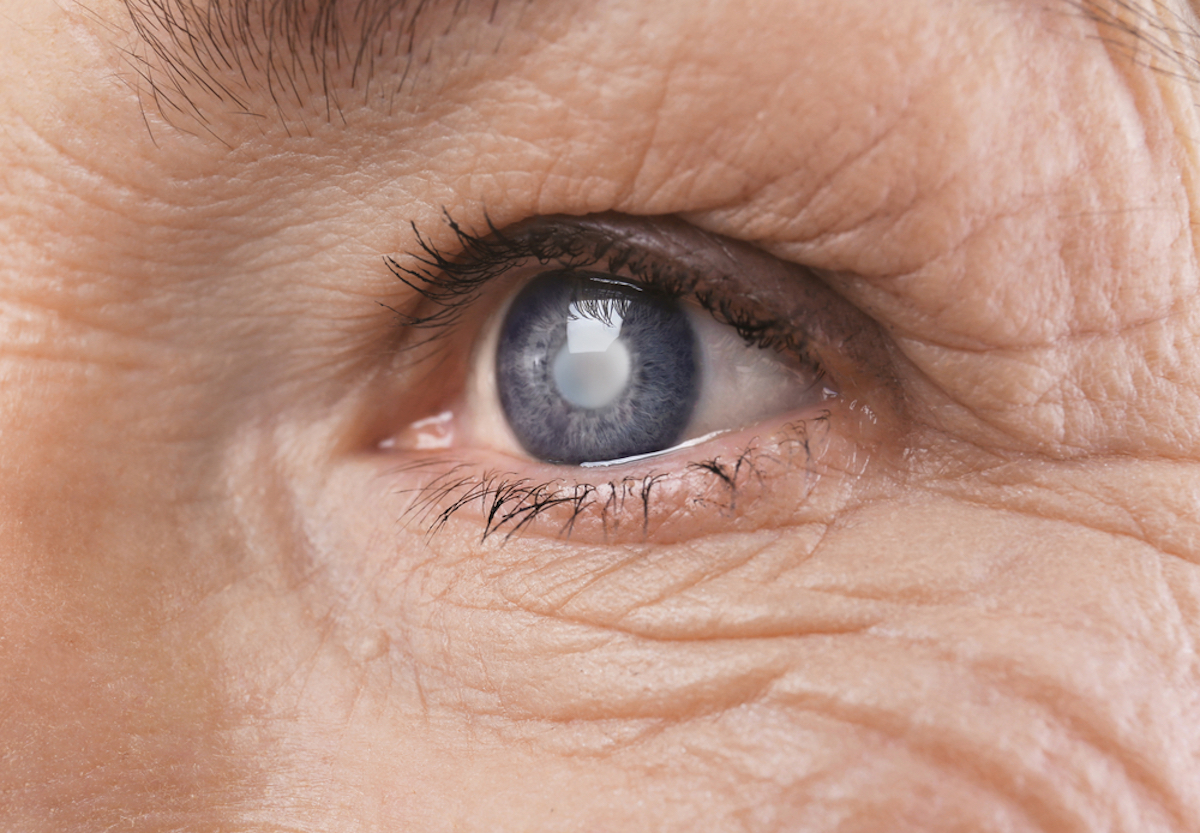 Cataract concept. Senior woman's eye, close-up