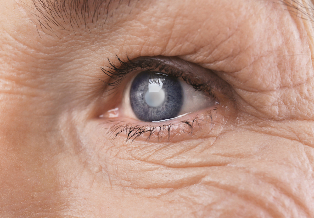 Cataract Concept Senior Woman's eye, close-up