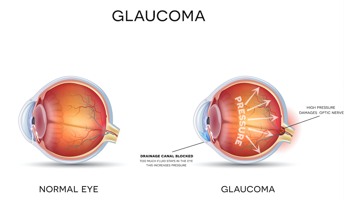 Glaucoma and healthy eye detailed structure.