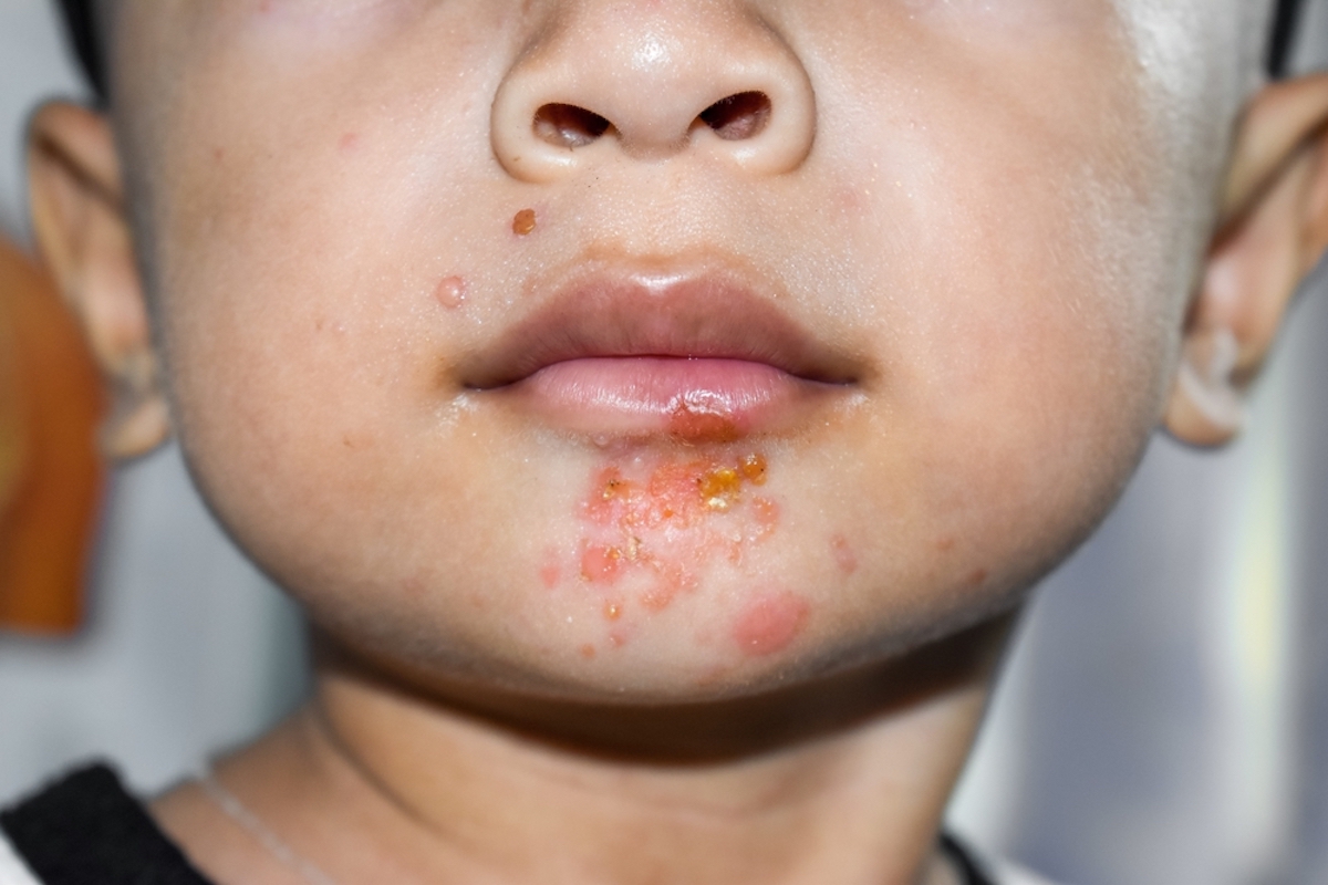 Staphylococcal skin infection called impetigo around mouth of Asian child. Impetigo
