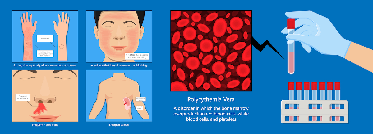 Polycythemia vera PV blood clots cancer bone marrow diagnostic complete count venous thromboses 