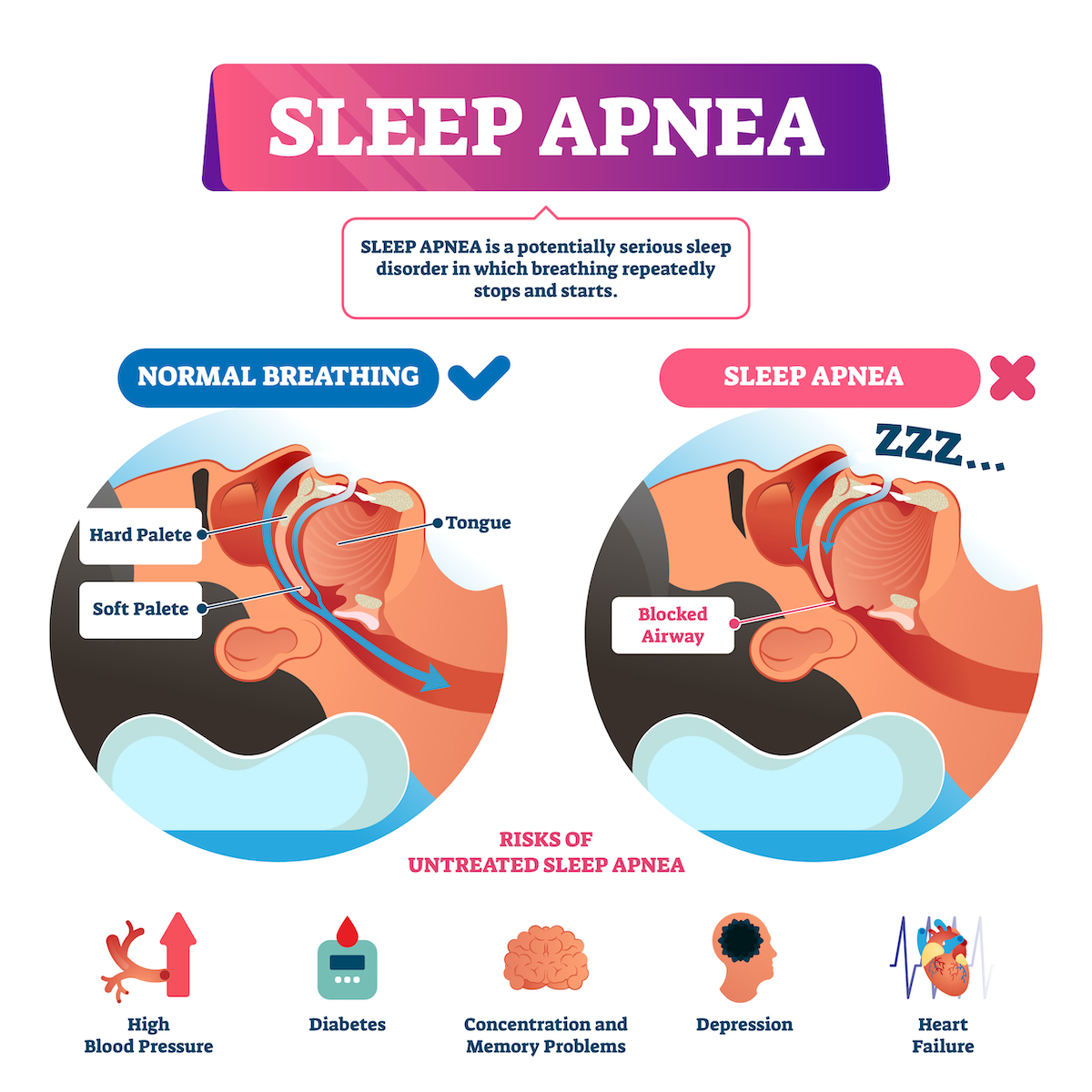 Sleep apnea vector illustration. Labeled nasal tongue blocked airway scheme. Diagram with normal and abnormal breathing comparison. Respiratory problem symptoms with list of untreated diagnosis risks.