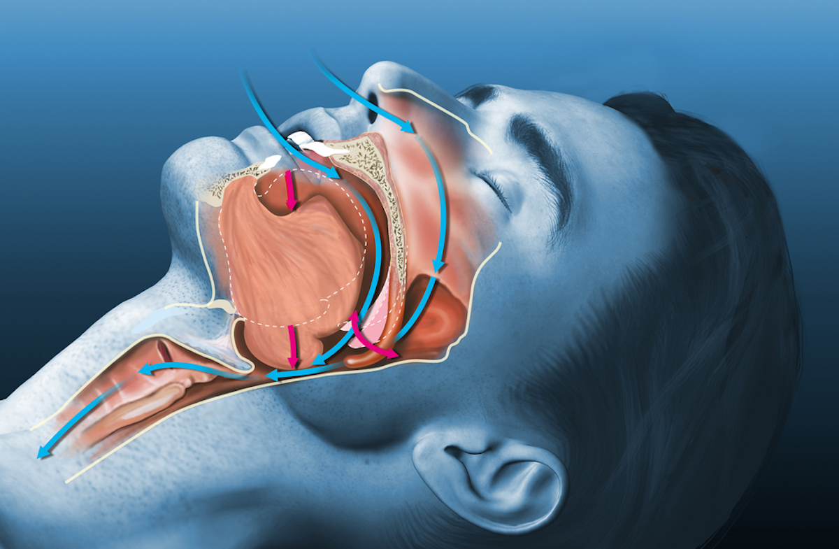 Medical 3D illustration shows a sleeping snoring man with sleep apnea