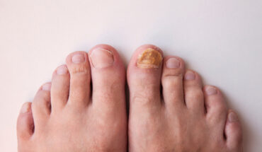 What Everyone Should Know About Nail Fungus