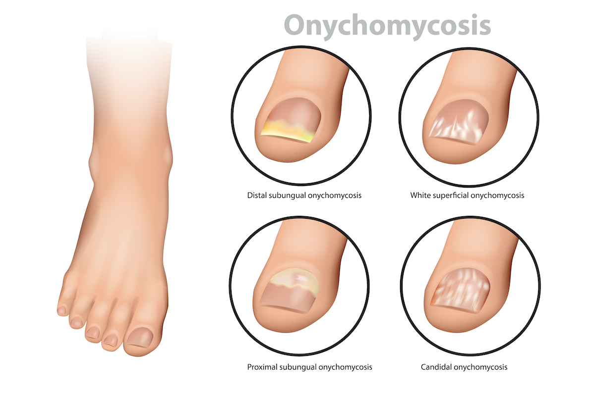 Fungal Nail Infection. Onychomycosis or tinea unguium. Four classic types of onychomycosis 