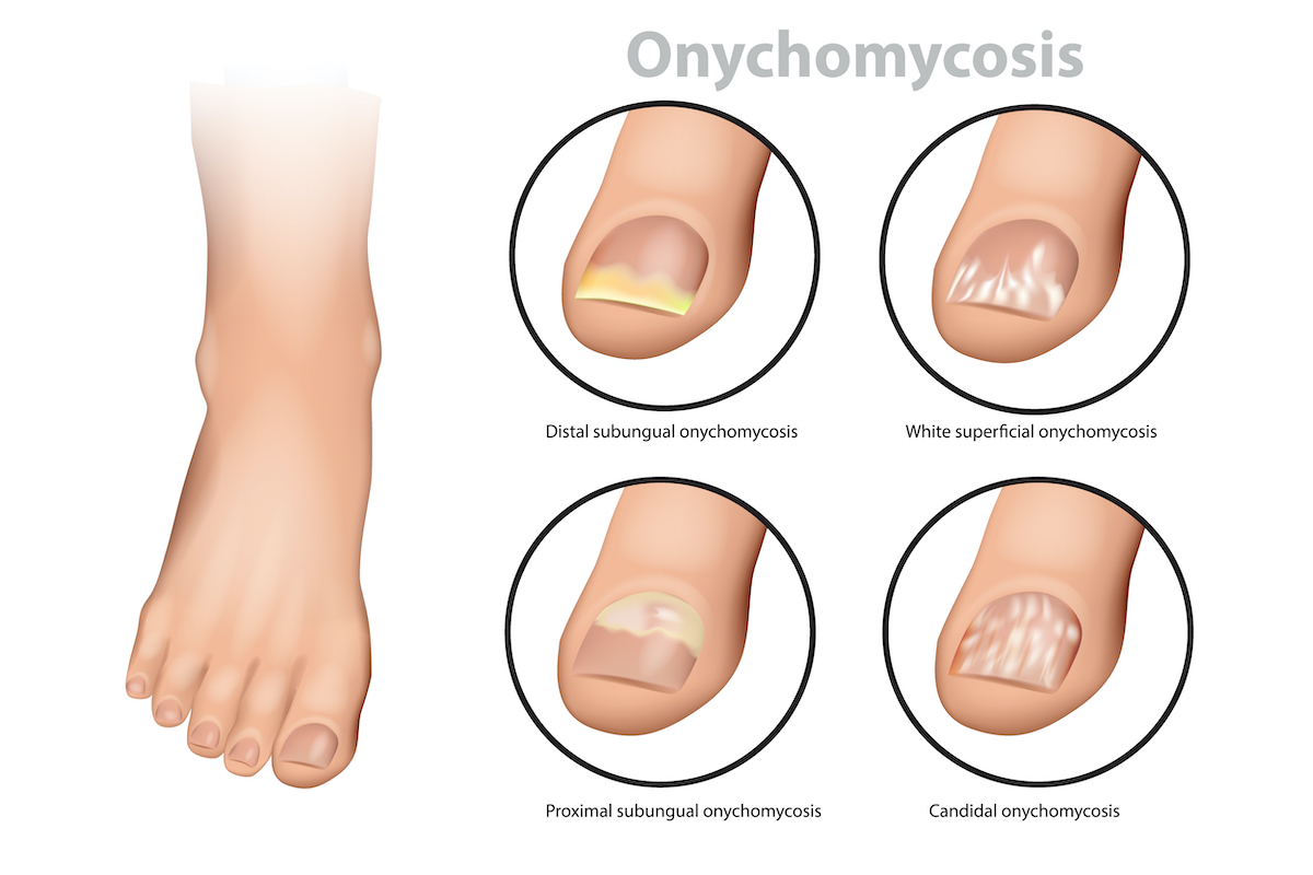 Fungal Nail Infection Onychomycosis or Tinea Unguium Four Classic Types of Onychomycosis 