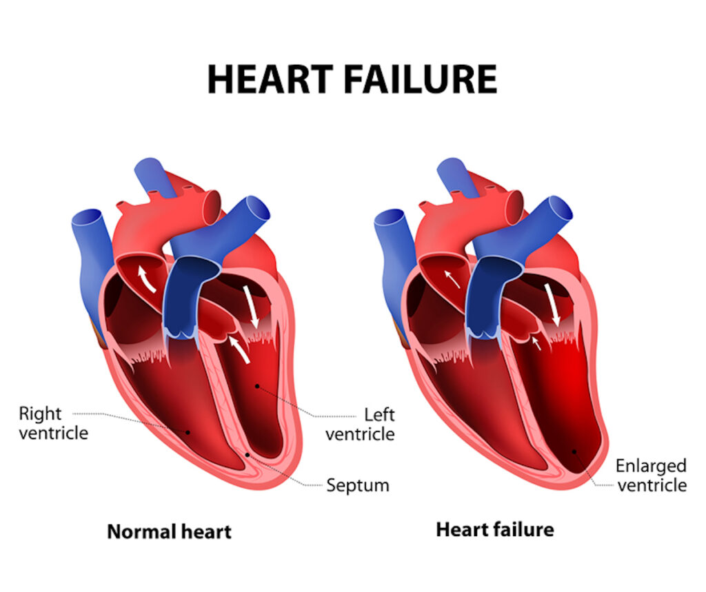 (Congestive) Heart Failure: Causes, Symptoms & Treatments