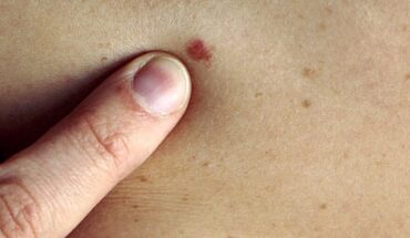 Skin Cancer: Causes, Types, Symptoms & Treatment Options