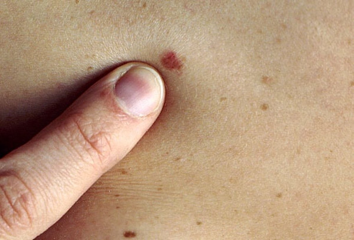 Zoomed-in photograph of possible melanoma. Skin cancer in birthmarks. 