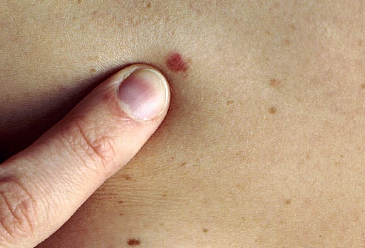 Zoomed in Photograph of Possible Melanoma Skin Cancer in Birthmarks