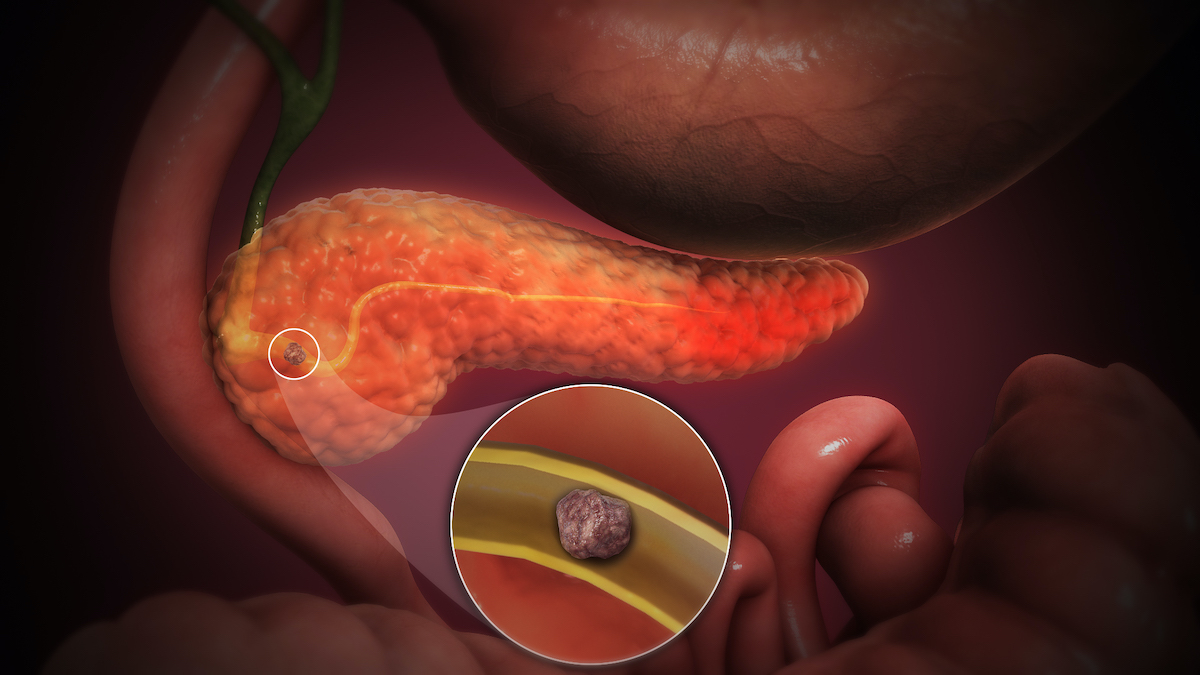 Illustration Showing Inflamed Pancreas Gallstones Blocking Bile Duct and Pancreatic Duct