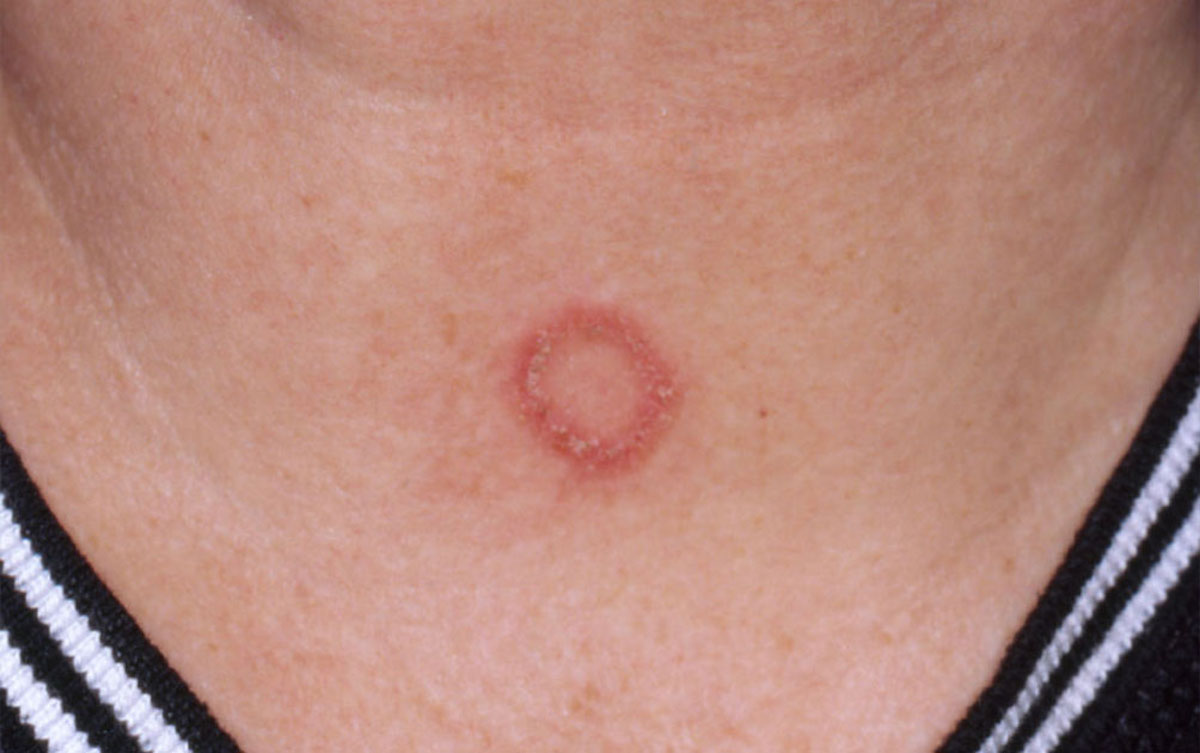 Ringworm on Throat