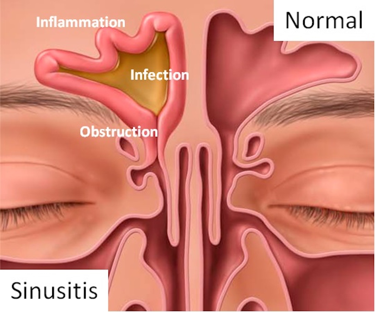 Sinusitis, frontitis.  Face with inflammation of mucous membrane of paranasal and frontal sinuses