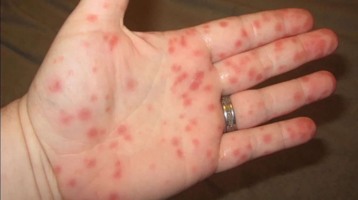 Strep Throat Rash on hand palm and fingers