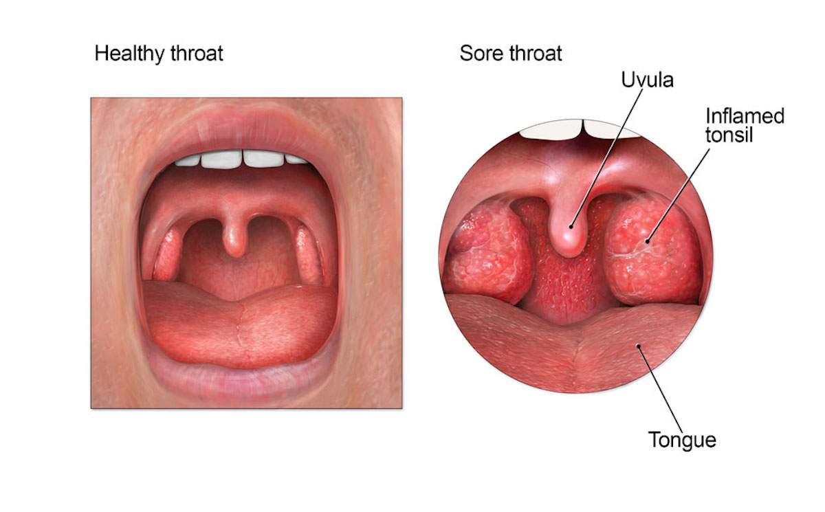 Comparison between normal tonsils and inflamed tonsils.