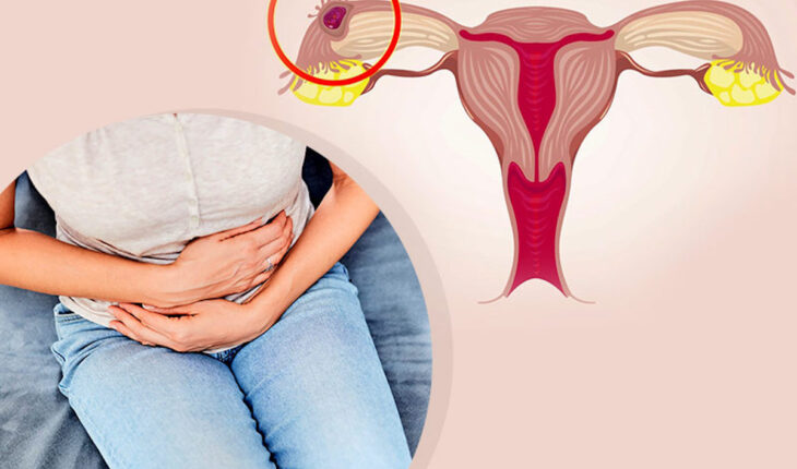 Everything You Should Know About Ectopic Pregnancy