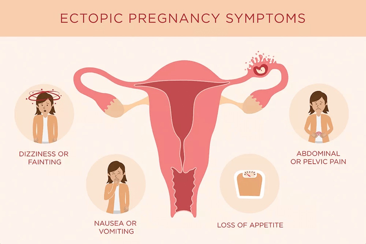 Infographic of ectopic pregnancy symptoms