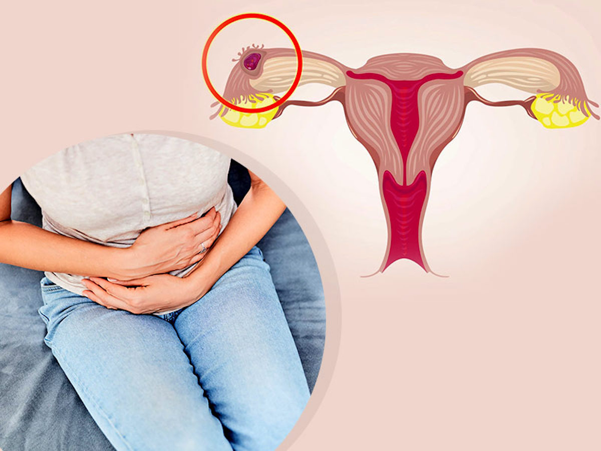 Everything You Should Know About Ectopic Pregnancy