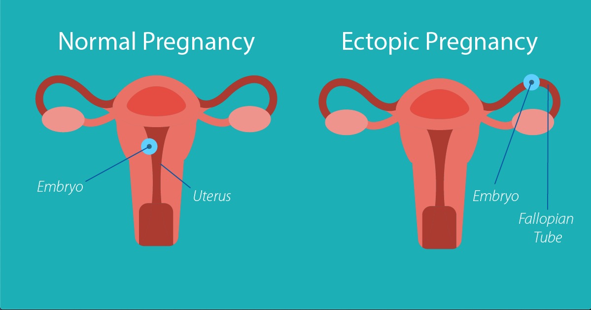 Anatomical Difference Between Normal Pregnancy and Ectopic Pregnancy