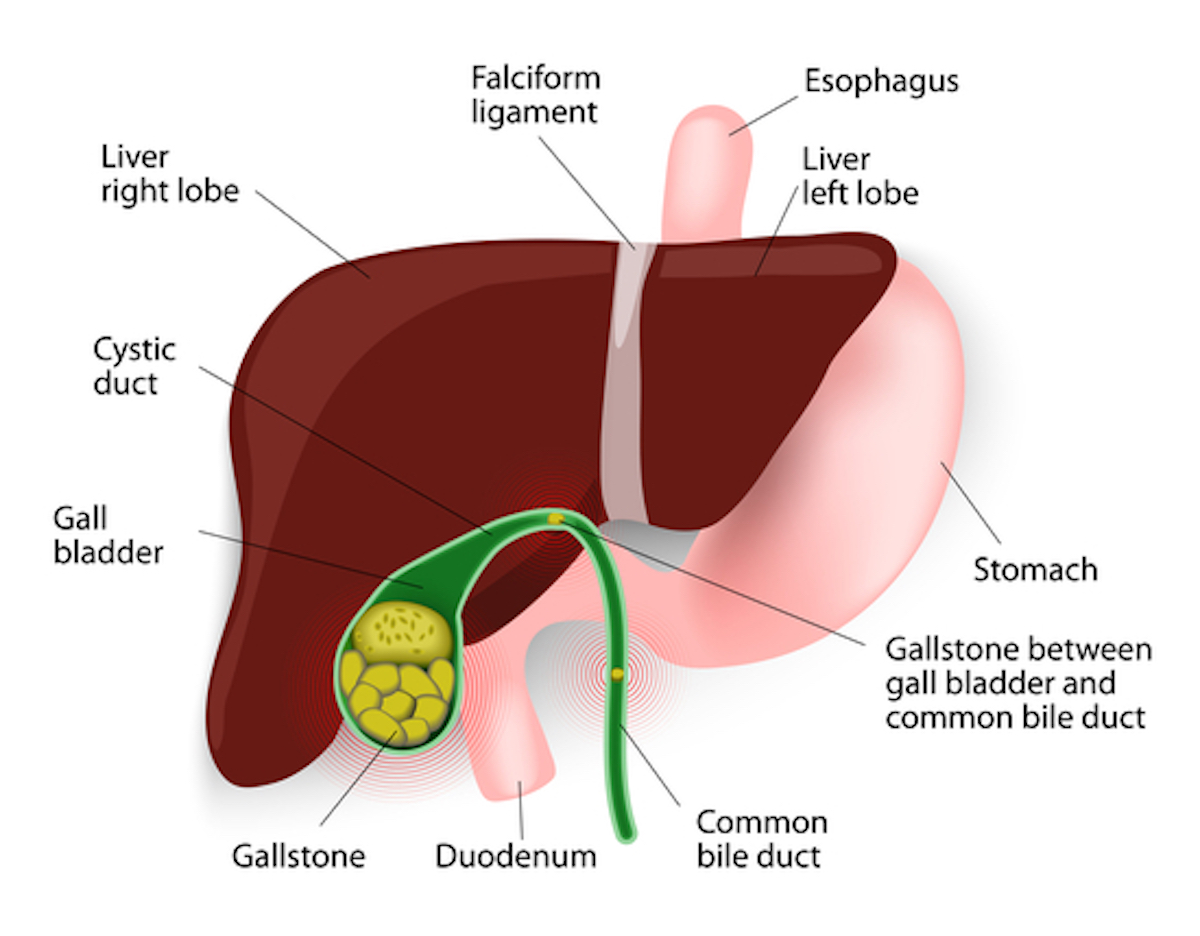 Gallstones develop because cholesterol and pigments in bile sometimes form hard particles. Cholesterol stones and pigment stones
