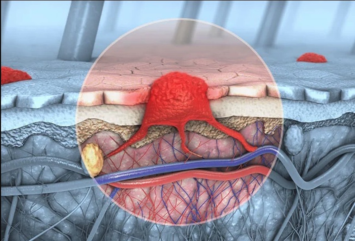 Melanoma or skin cancer. This rare form of skin cancer originates from melanocytes. layers of human skin.