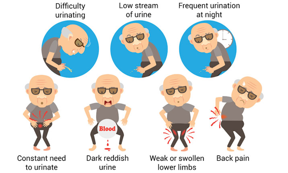 Symptoms of prostate cancer