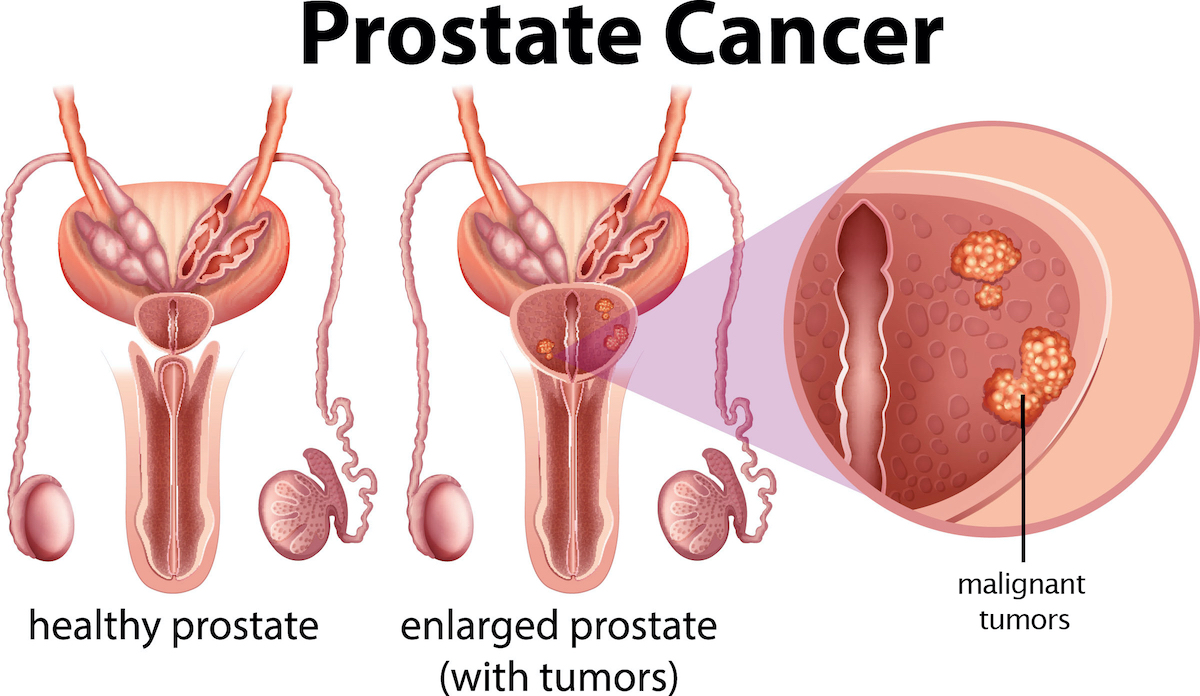 Diagram of illustration of prostate cancer