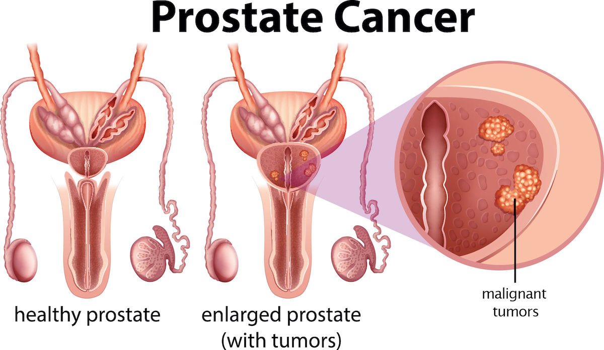 Diagram of Illustration of Prostate Cancer