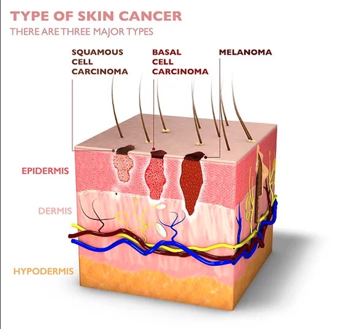 Types of Skin Cancer