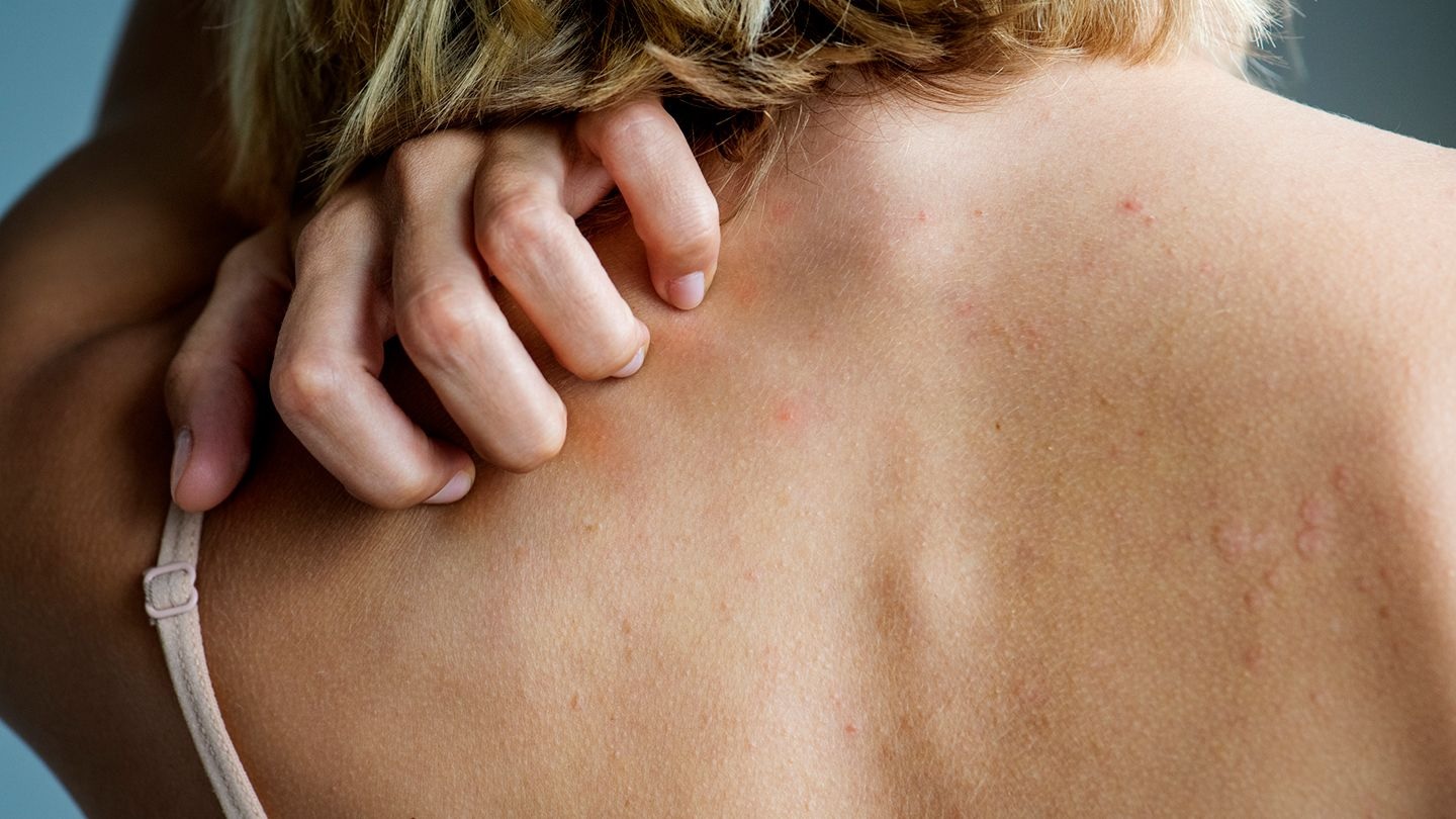 Caucasian blond woman scratching her back that contains red small bumps, possibly a skin rash.