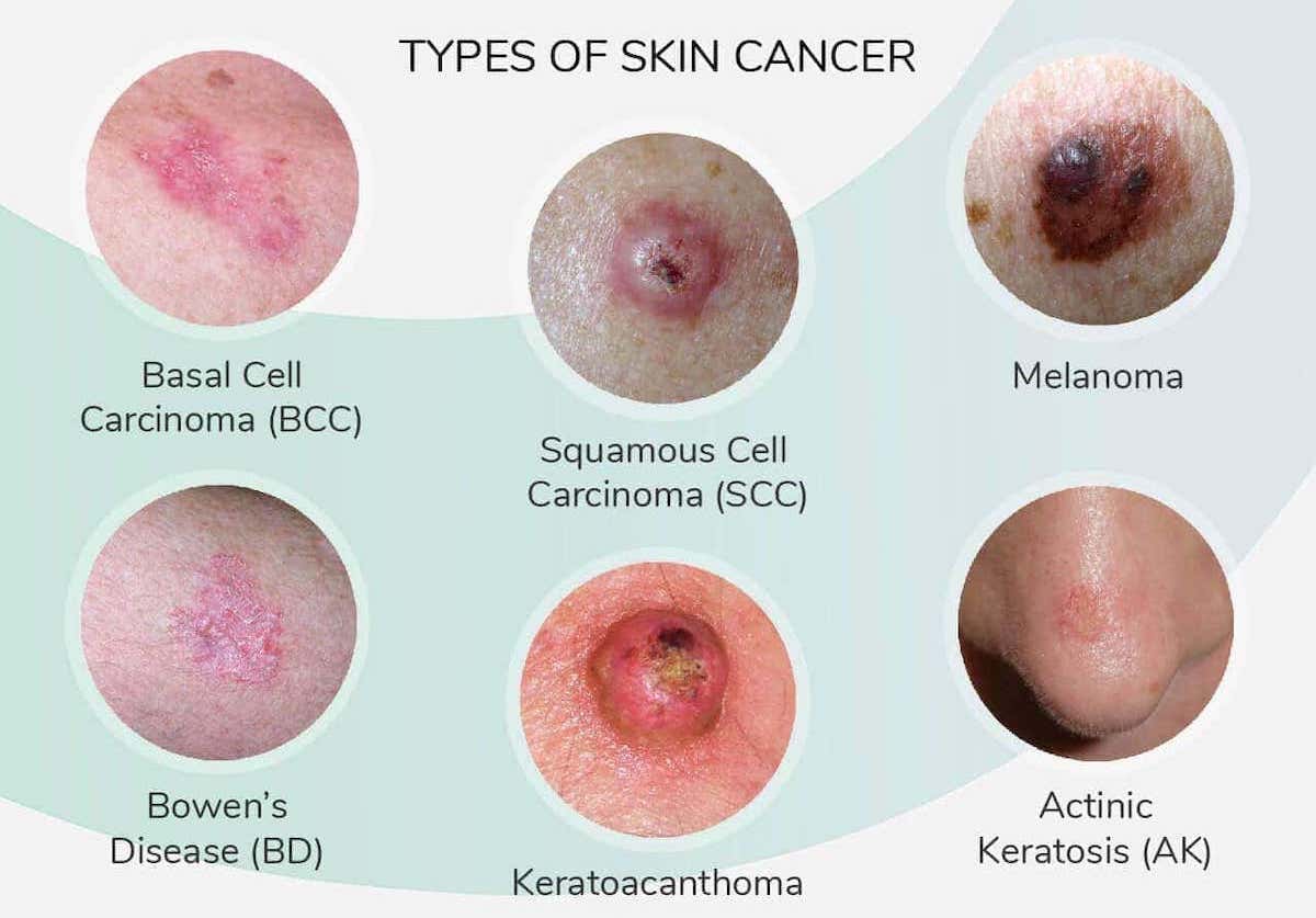 pictures of different types of skin cancer