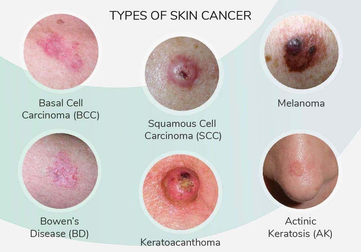 Pictures of Different Types of Skin Cancer