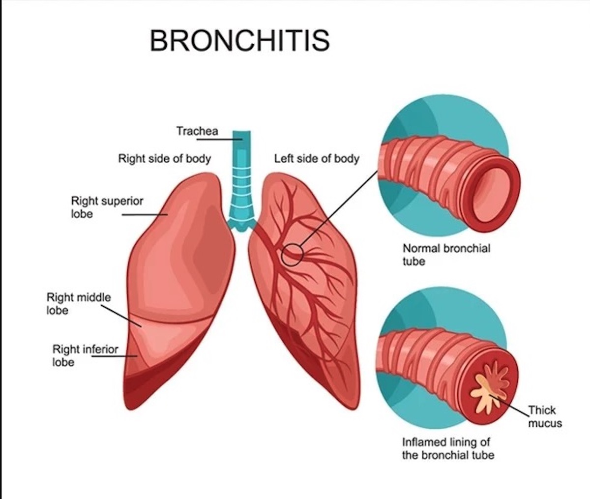 Bronchitis. Lungs and bronchial tubes. normal bronchial tube and a bronchial tube with bronchitis.
