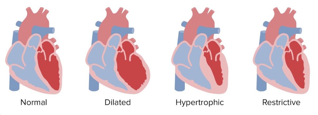 Cardiomyopathy: Causes, Types, Symptoms & Treatment Options