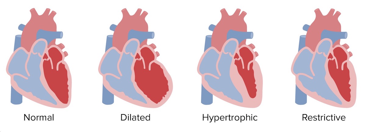 Heart attack artery hypertrophy chamber stress stiff stretched high blood pressure valve right and left edema chest pain lupus immune system disorder arrest. Cardiomyopathy types