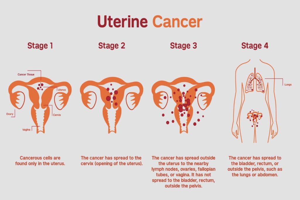 how-long-can-you-live-with-stage-1-uterine-cancer-youtube