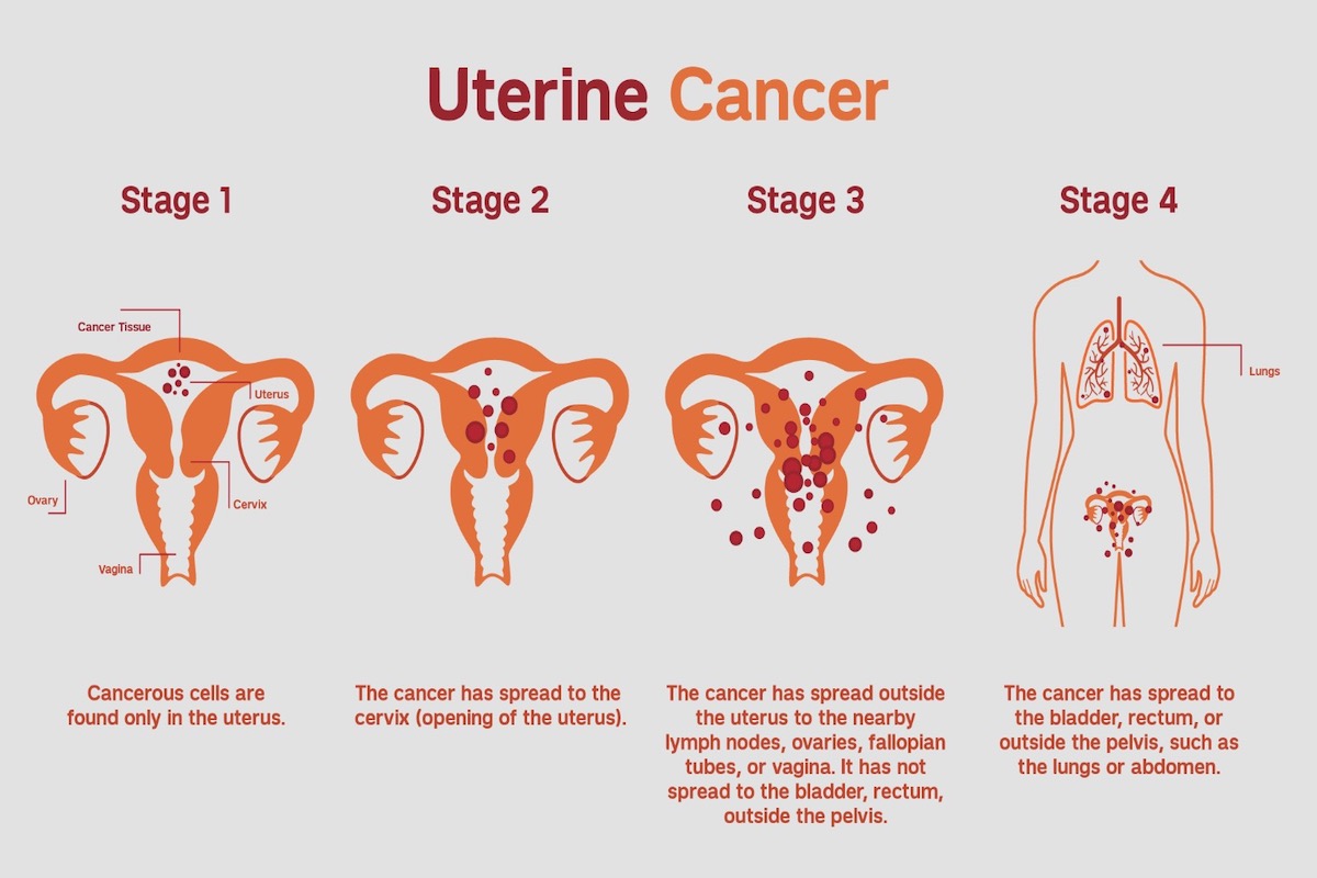 stages of uterine cancer