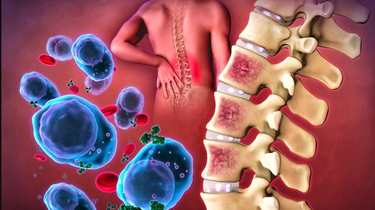 Multiple Myeloma