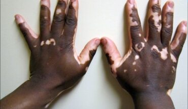 Vitiligo: Types, Symptoms & Treatment Options